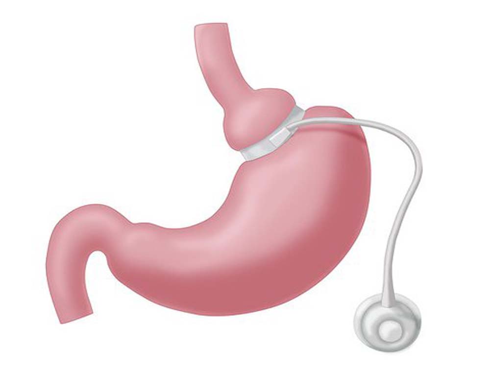 Adjustable Gastric Band in Kampala Uganda. Leading Medical Supplies Companies in Uganda, Hospital Equipment, Medical Supplies, Healthcare, Medicare, Dental Equipment, Clinical Equipment, Medical Devices, Medical Machinery, Diagnostic Equipment, Scientific, Laboratory, Medical Instruments, Medical Supply & Supplier Companies in Uganda, Ugabox